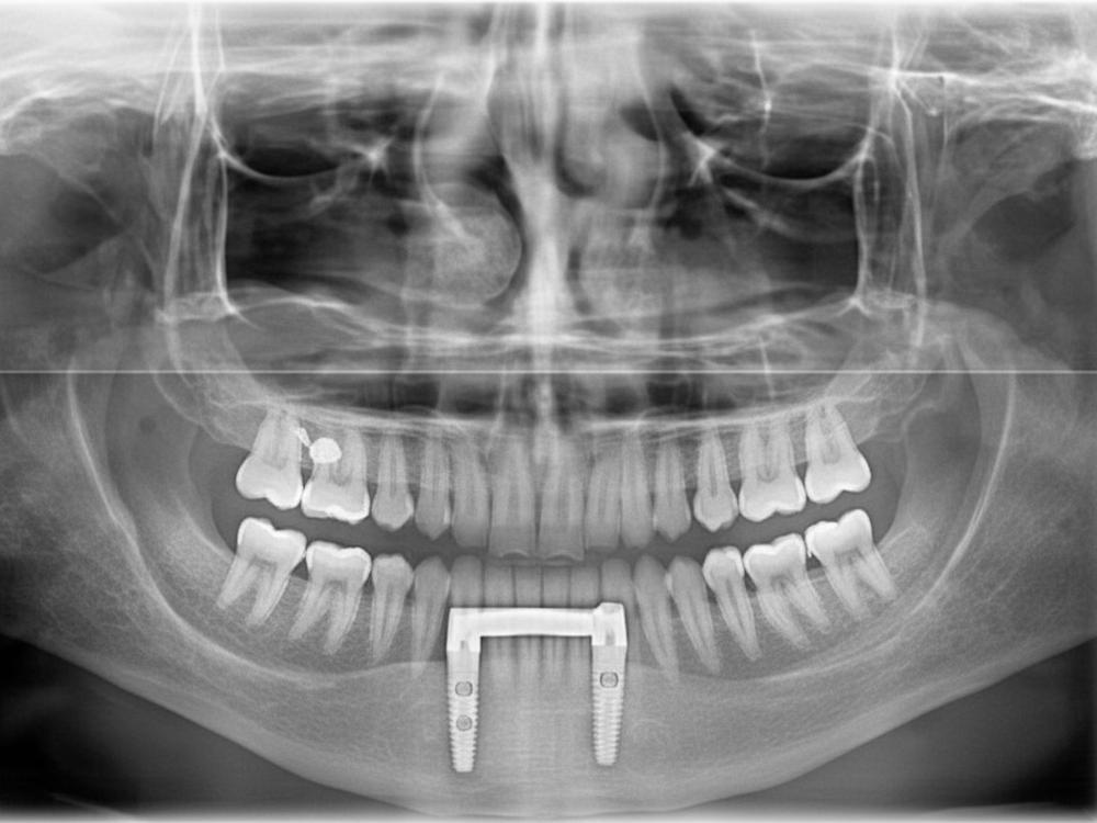 Clinical criteria for immediate-loading protocols