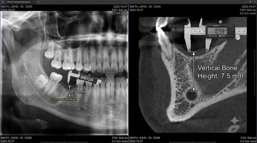 NTA Shorter (5.0 × 6.0 mm) in the posterior mandible with limited vertical bone: 5-year stability follow-up
